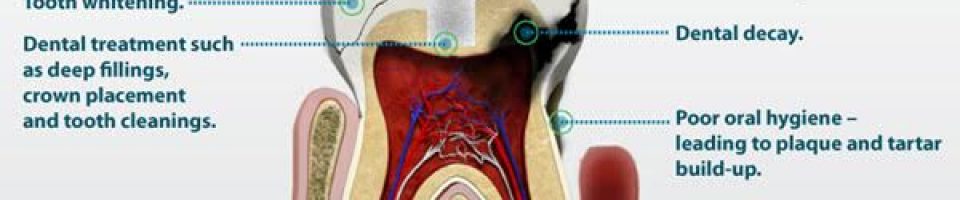 Tooth sensitivity causes