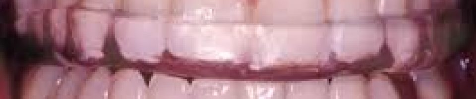 Teeth grinding photo