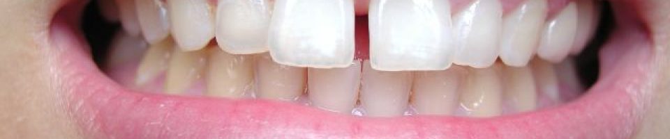 Gap between teeth that needs to be fixed Gapped teeth