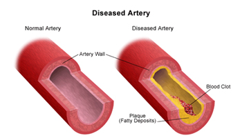 carotid artery
