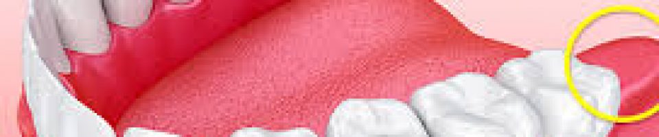 Wisdom tooth extraction