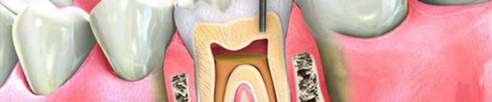 root canal therapy