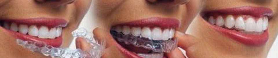 invisalign braces