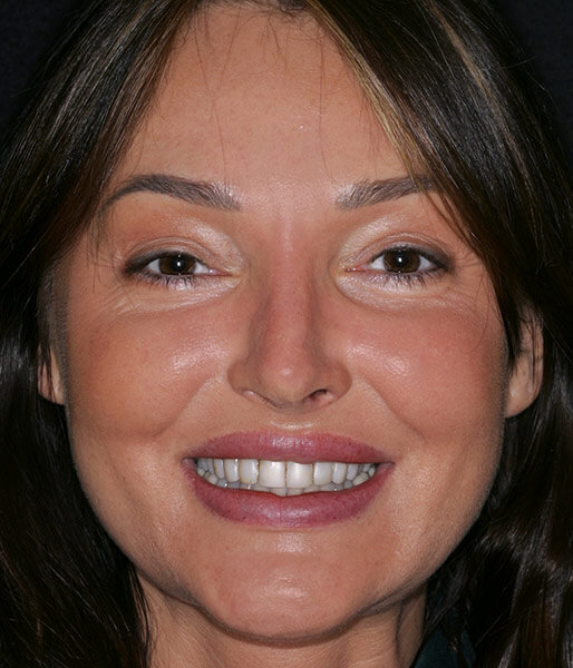 Veneers Before & After Photo