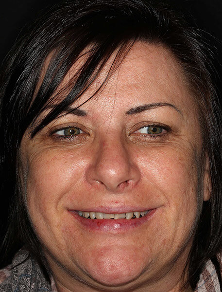 Veneers Before & After Photo