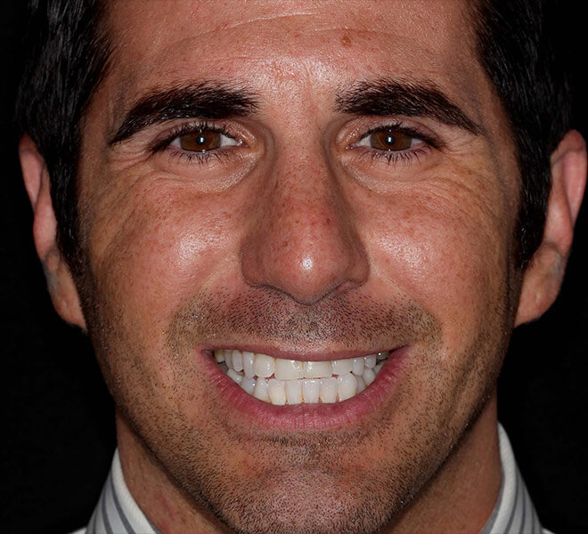 Veneers Before & After Photo